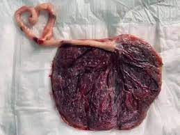Placenta and white cord